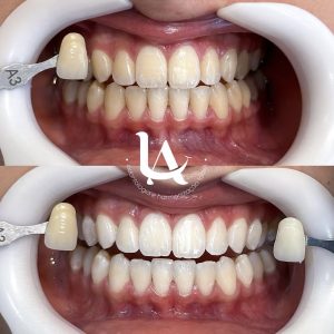 Clareamentod ental em cAmpo grande