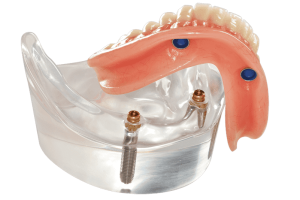 overdenture