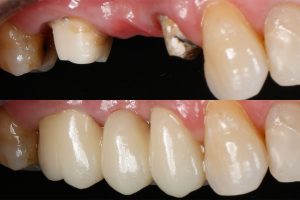 protese parcial sobre dente